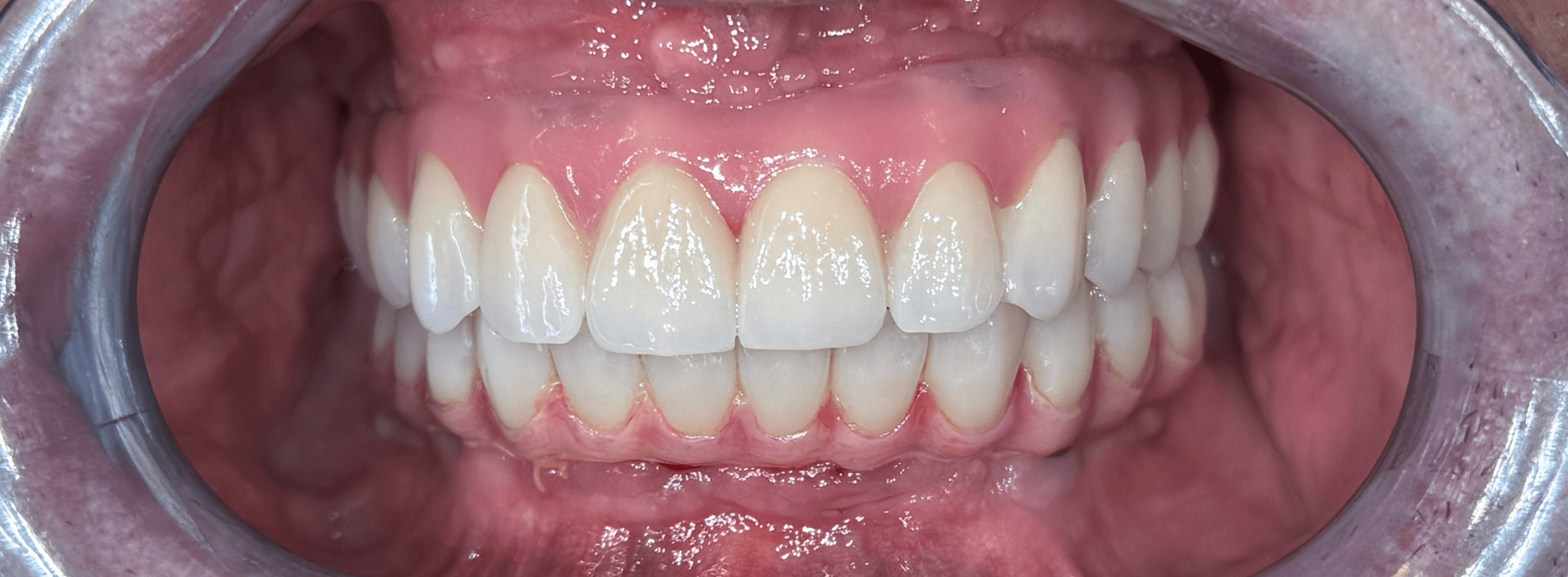 Superior: All on 5, inferior: All on 6, din zirconiu