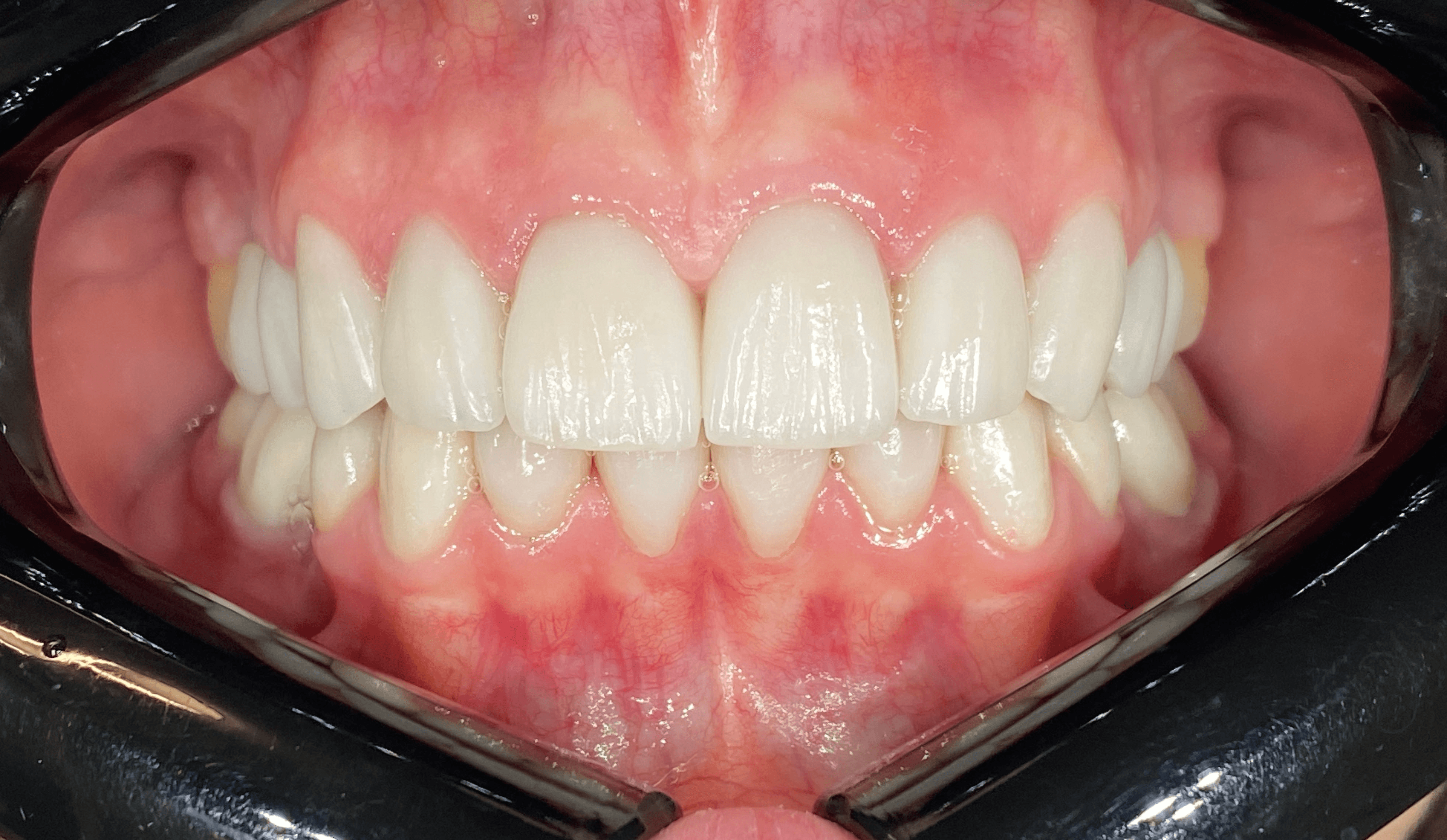 Full mouth: Coroane, fațete și coroane pe implant din EMAX
